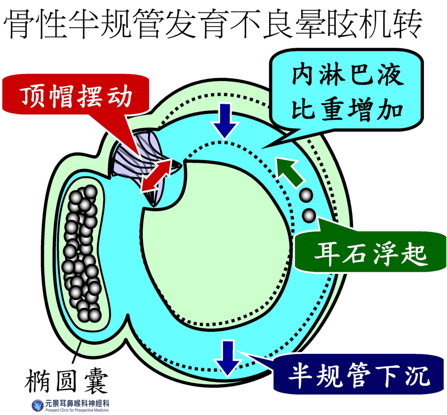 快速转头就晕眩不适?台湾晕眩名医师建议,先治内耳发炎再治疗